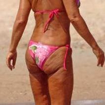 cellulite on a skinny body