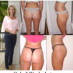 Cellulite Before and After Photos from Nicki