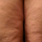 Skin Tightening Treatments for Cellulite
