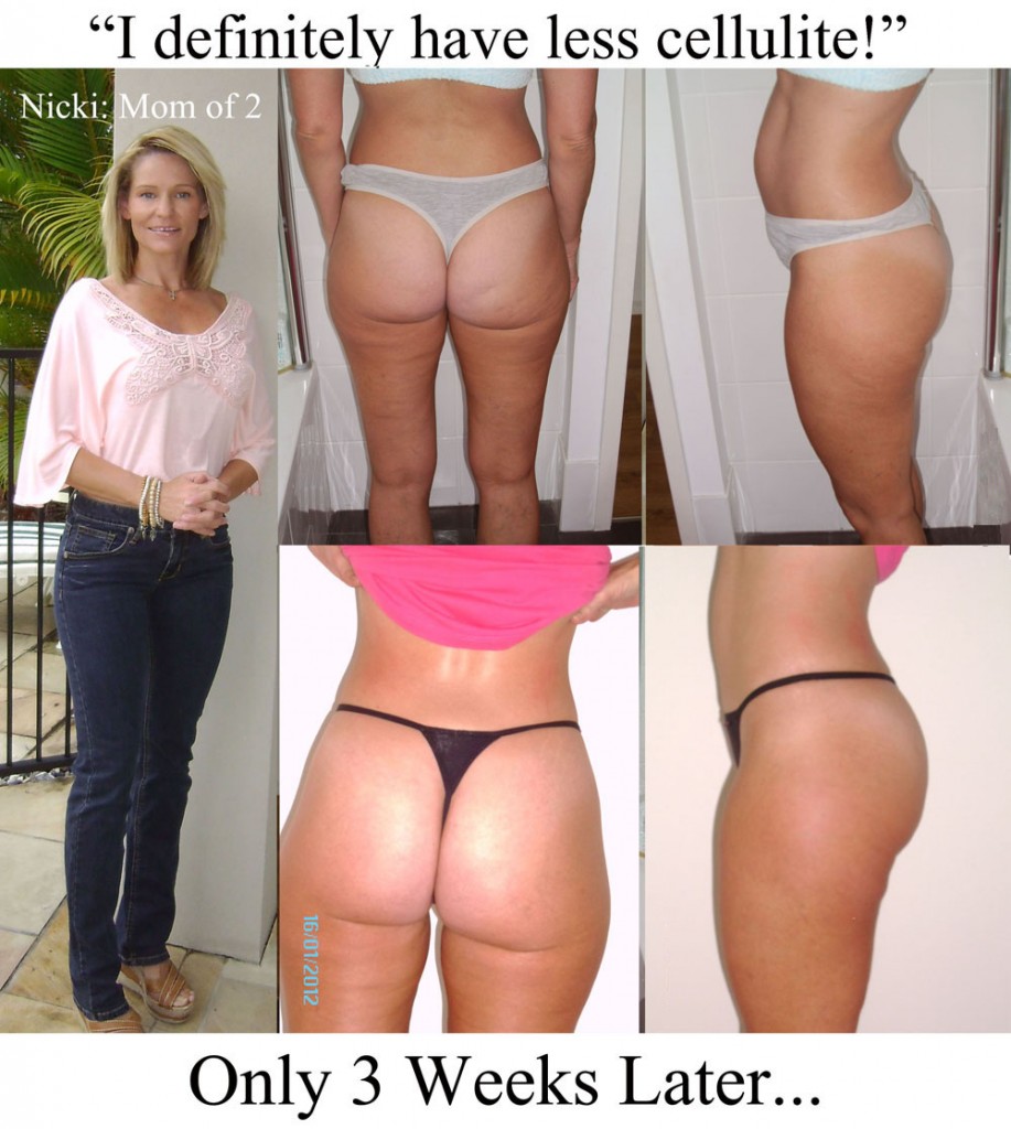 Nicki's Proof of Cellulite Reduction at 3 Weeks